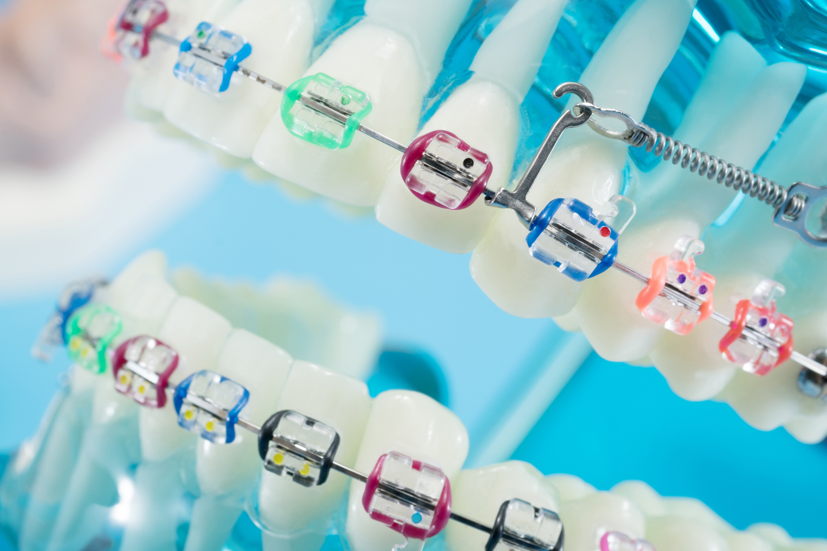 Me acabo de poner Brackets ¿Que cuidados debo tener?