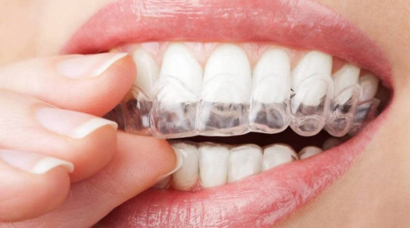 Brackets Invisibles INVISALIGN