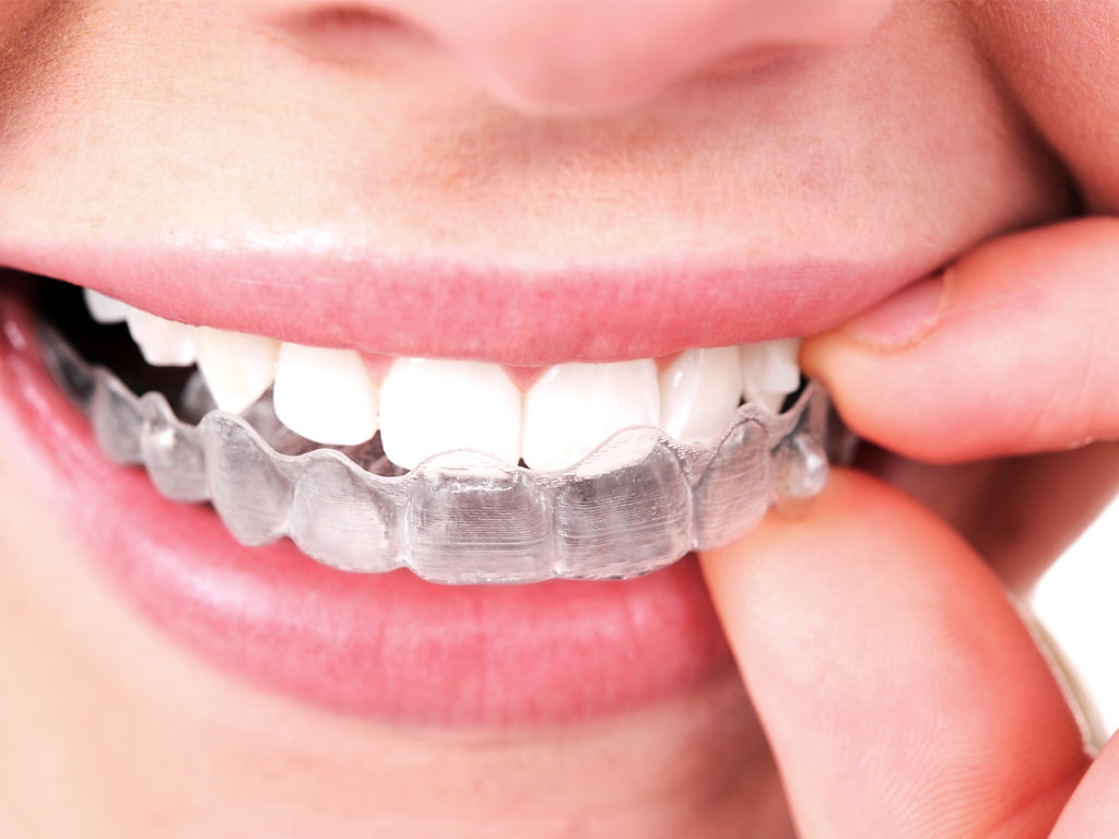Todo sobre Invisalign la ortodoncia sin brackets