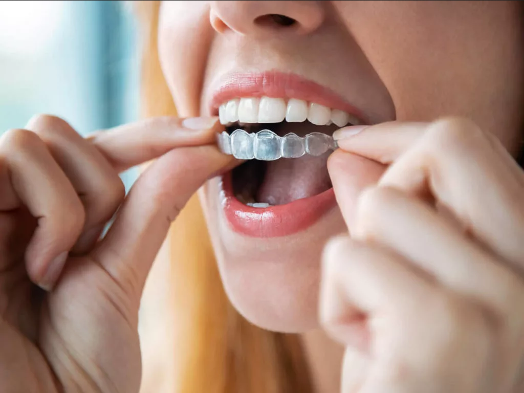 ¿Quiénes pueden usar Invisalign?