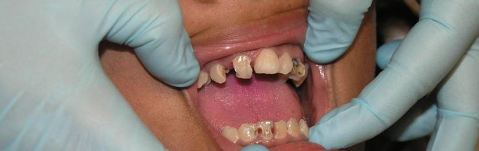 Cinco malos hábitos que podrían arruinar tus dientes