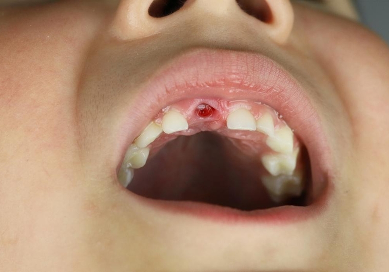 ¿Qué significa soñar que se te caen los dientes?