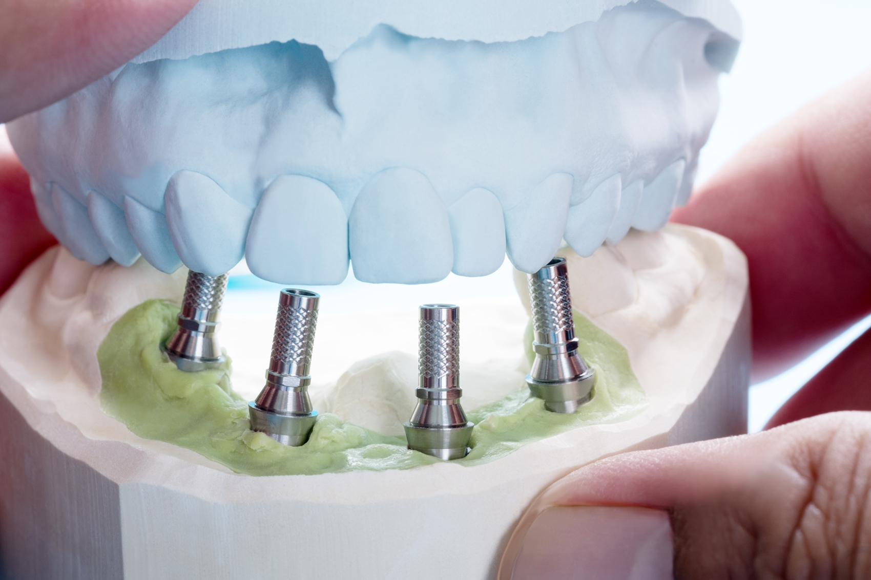 La importancia de los Implantes Dentales