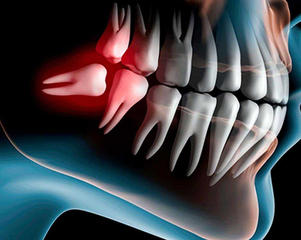 Las muelas del juicio: extracción y post operatorio