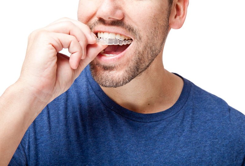 Ortodoncia Invisible Invisalign